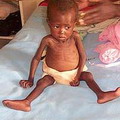 位於辛巴威的營養不良小孩。圖片來源：Iowa DOT