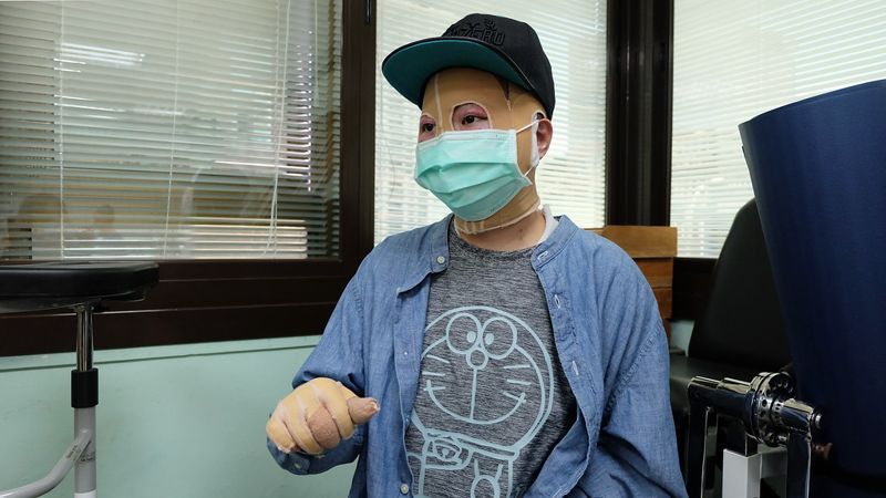 不需再忍耐！ 燒燙傷傷友夏天防疫有解 吹冷氣不用關窗也通風